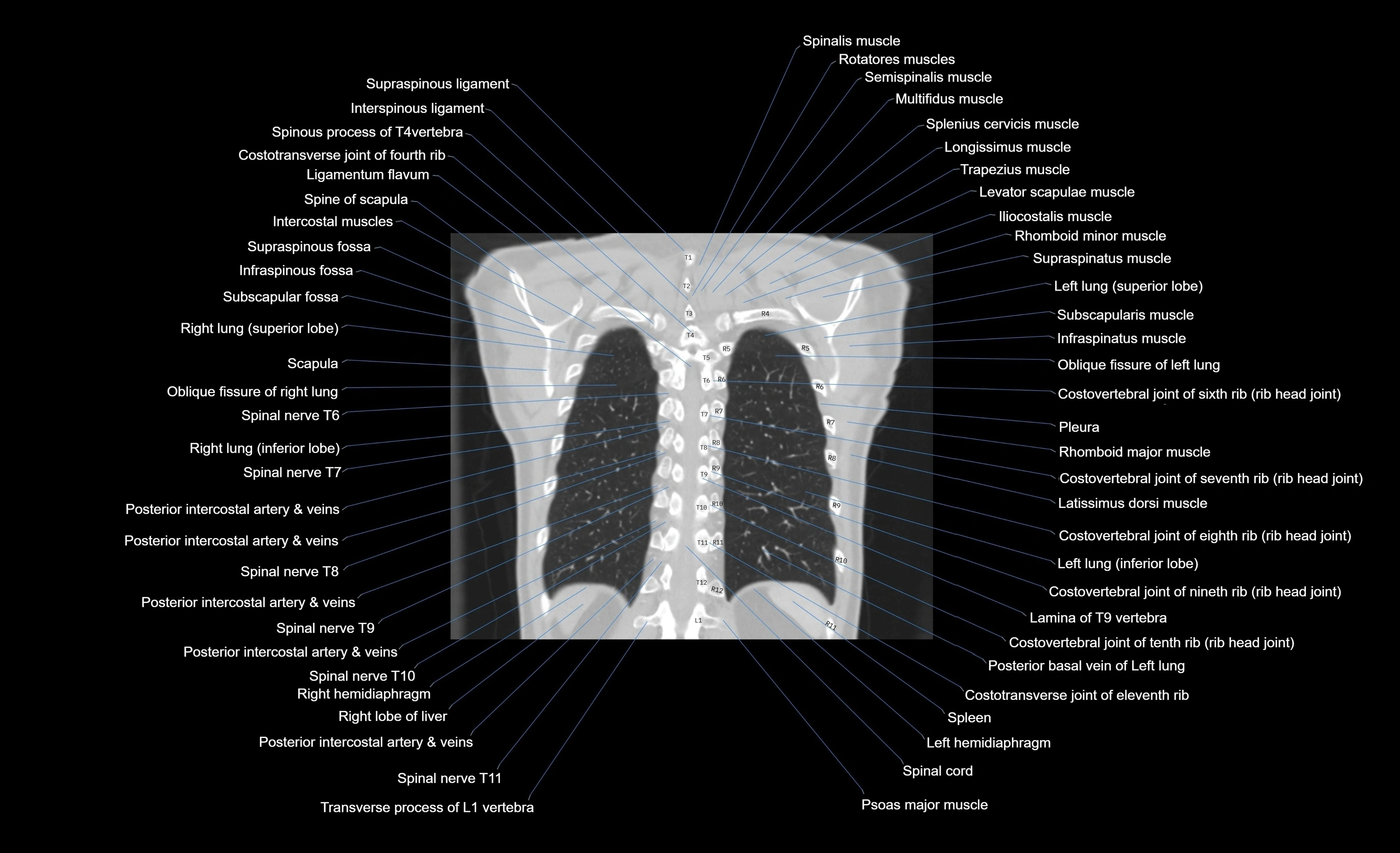 CT chest (thorax) lung window window labelled coronal cross sectional anatomy radiology image-00026.webp